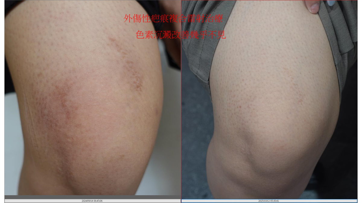 膝蓋外傷疤痕治療前後對比