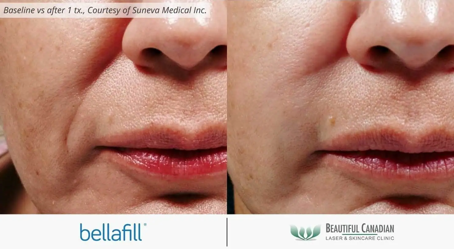 How Long Does Bellafill Last? Your Complete 2025 Guide to Long-Lasting Results 6 Bellafill treatment areas
