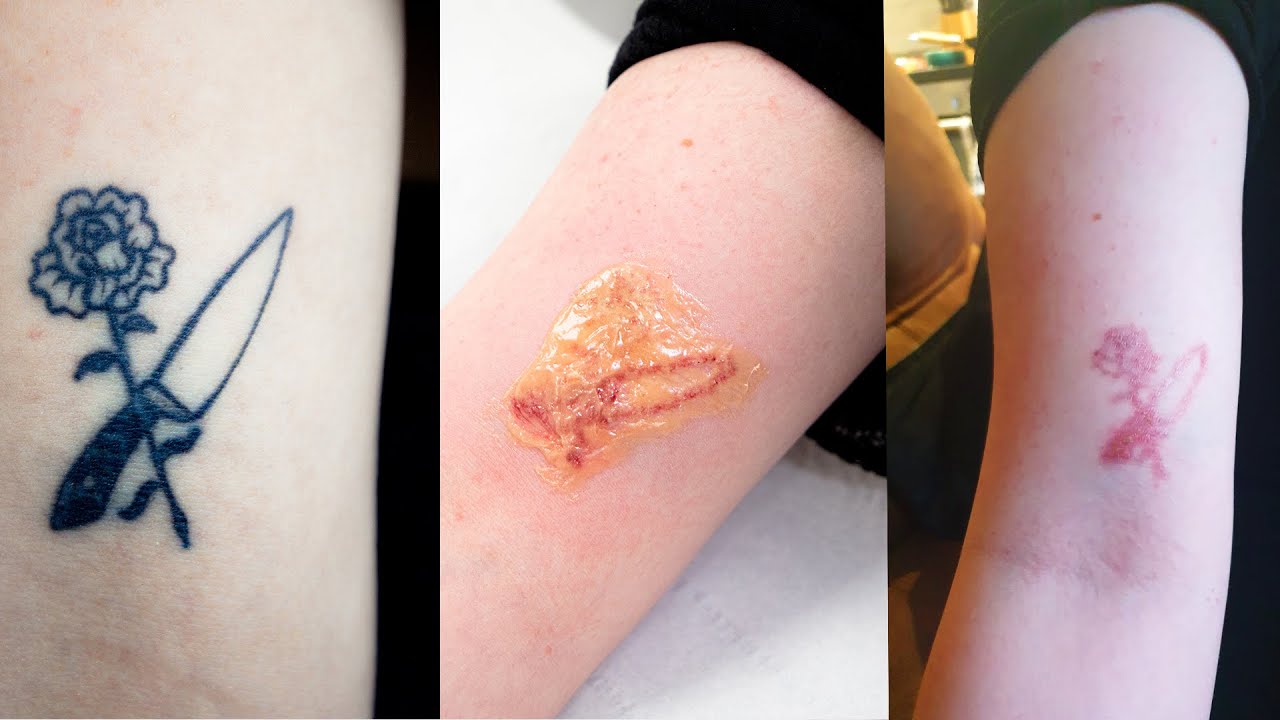 How Much Does Tattoo Removal Cost? Your Complete 2025 Guide 2 Laser Tattoo Removal Procedure