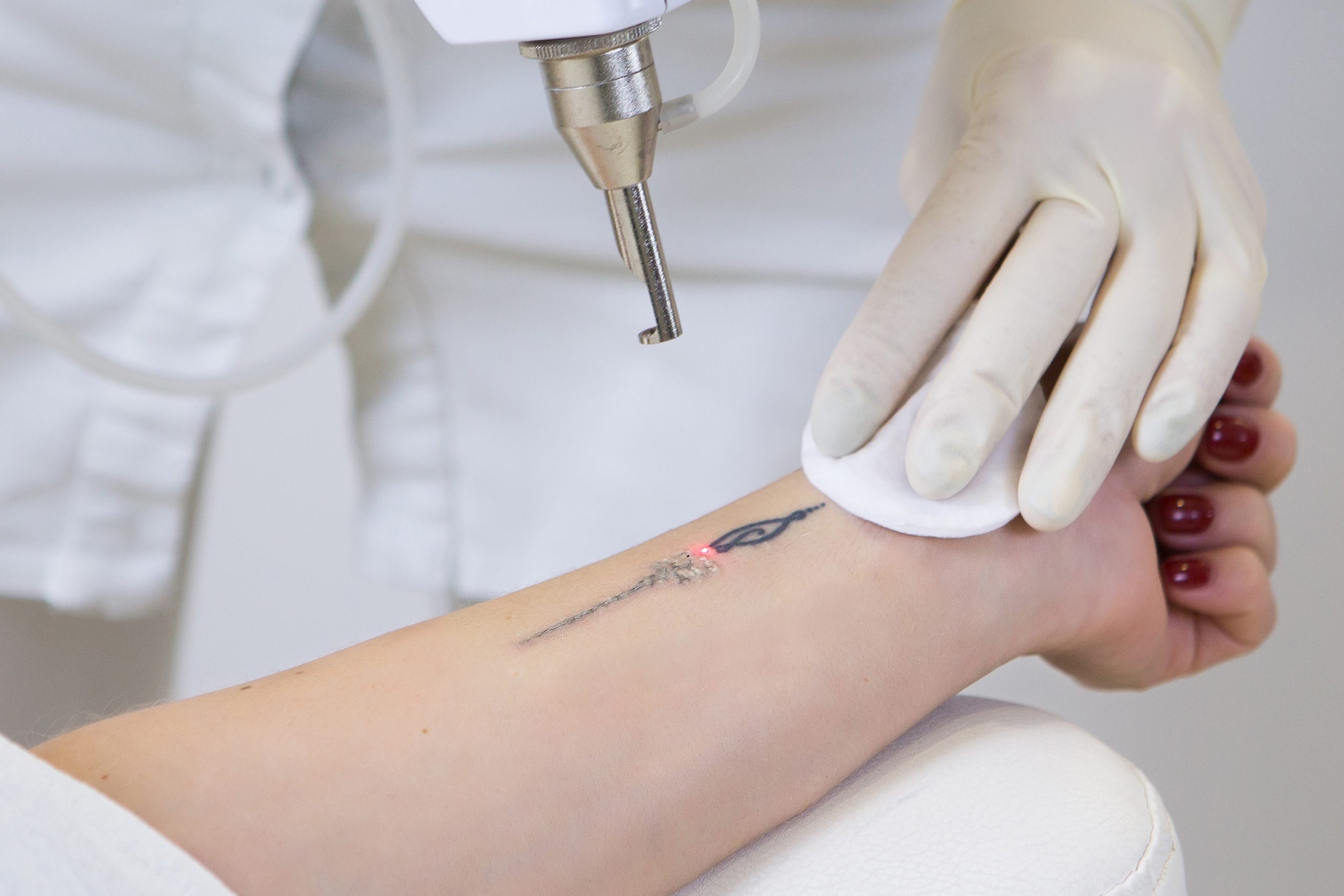 How Much Does Tattoo Removal Cost? Your Complete 2025 Guide 4 factors affecting tattoo removal cost