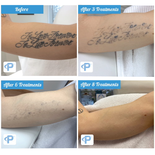 How Much Does Tattoo Removal Cost? Your Complete 2025 Guide 7 Before and After tattoo removal Results