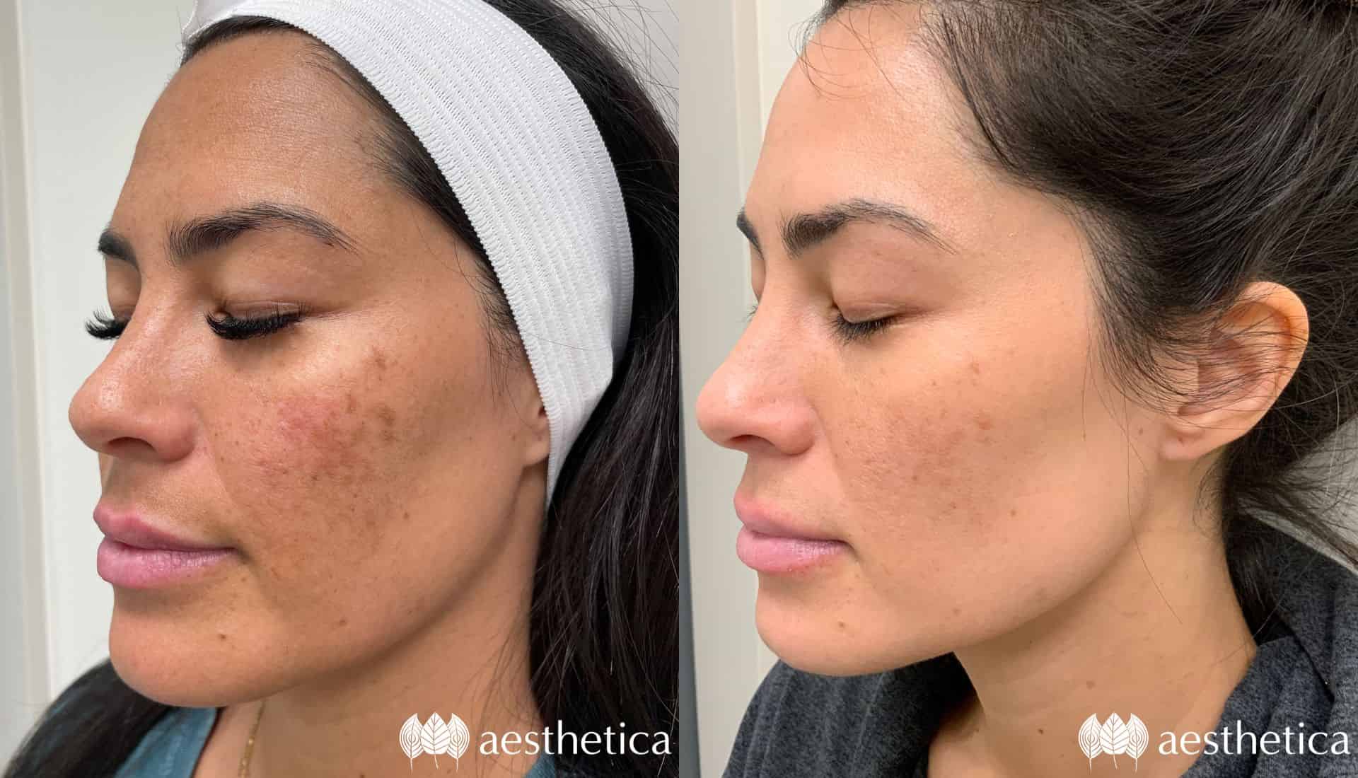 How Much Is a Chemical Peel? Complete 2025 Cost Guide 5 Popular Chemical Peel Treatment