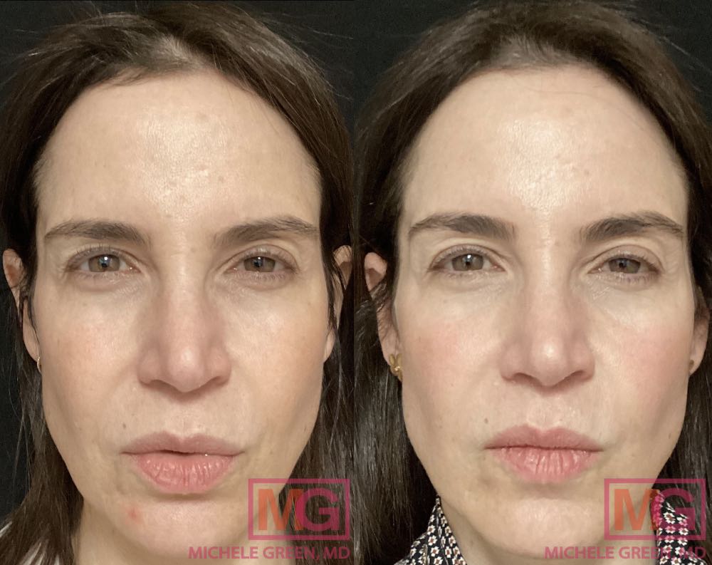 How Much Is a Chemical Peel? Complete 2025 Cost Guide 10 chemical peel before and after