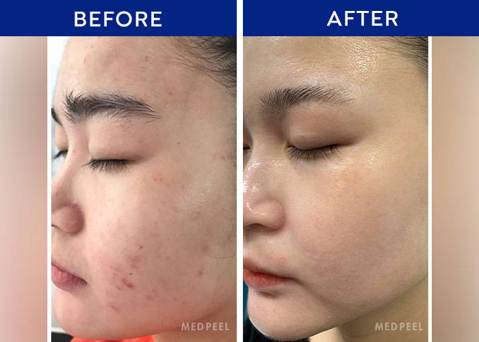 How Much Is a Chemical Peel? Complete 2025 Cost Guide 12 chemical peel Before and After Results