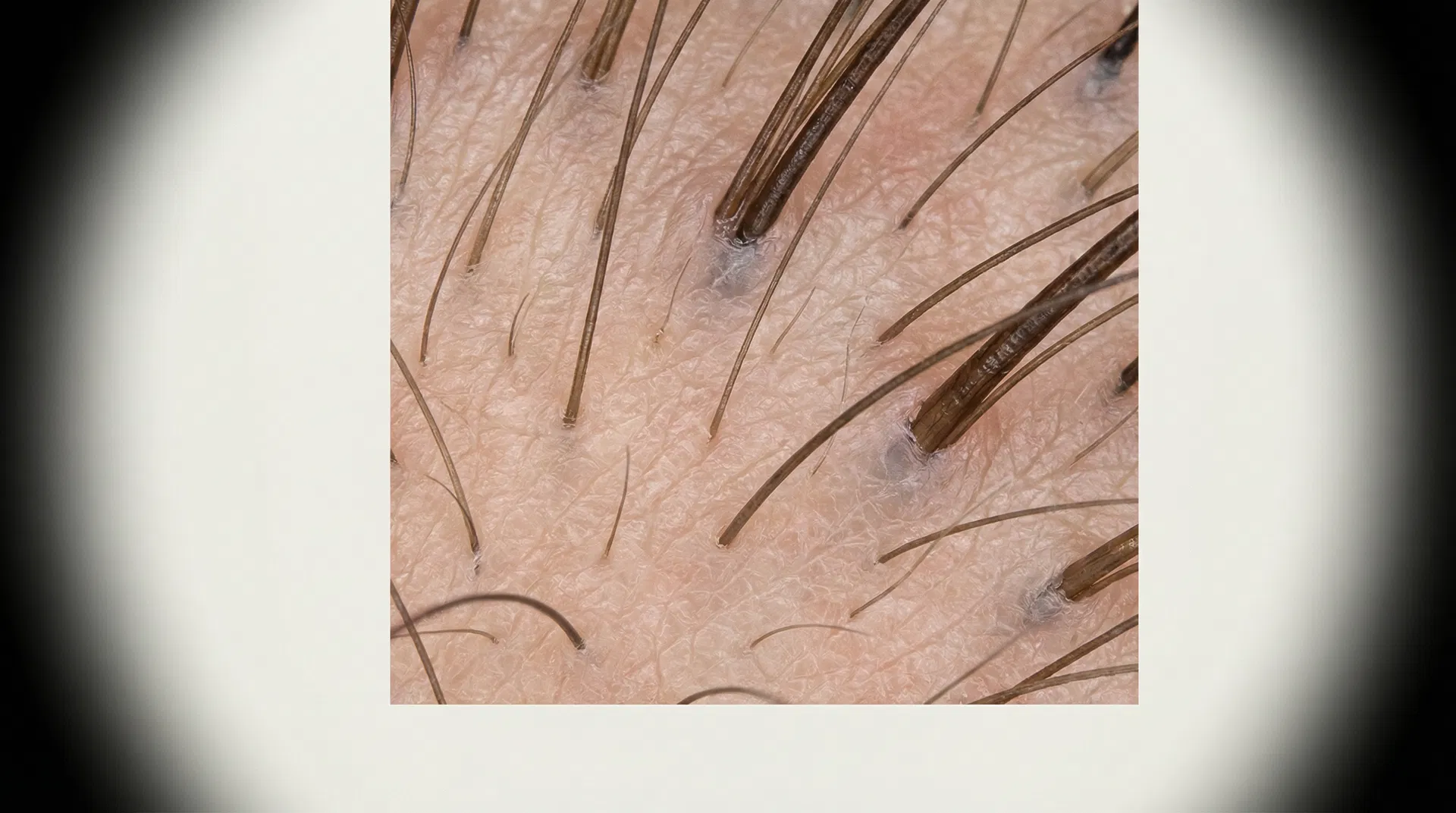 Vue microscopique du cuir chevelu