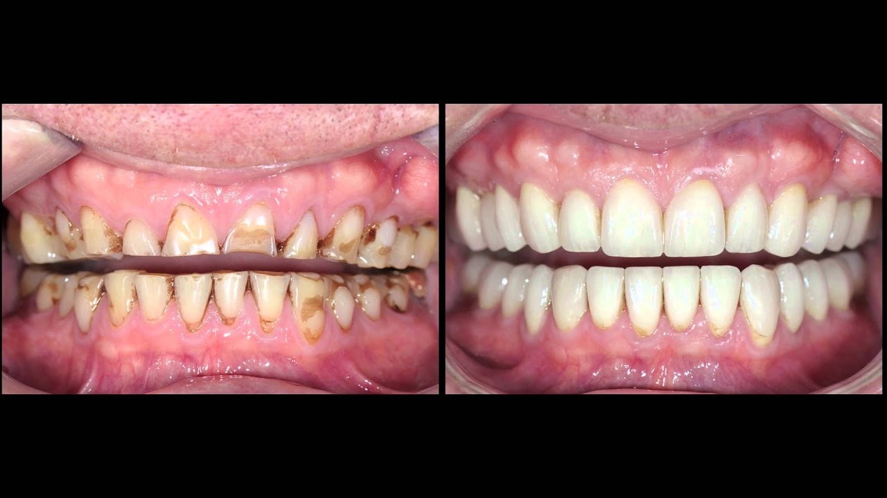 Exemplo de uma reabilitação oral completa que restaura a função e a estética.