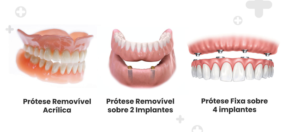Ilustração mostrando diferentes tipos de próteses dentárias.