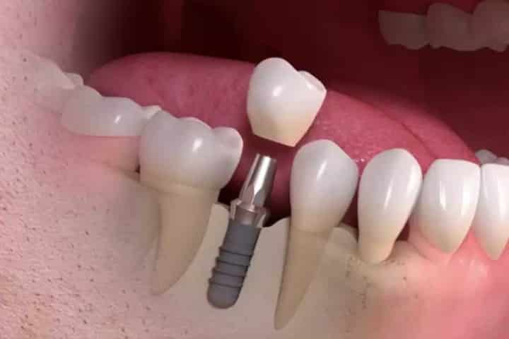 Ilustração mostrando a manutenção de implantes dentários.