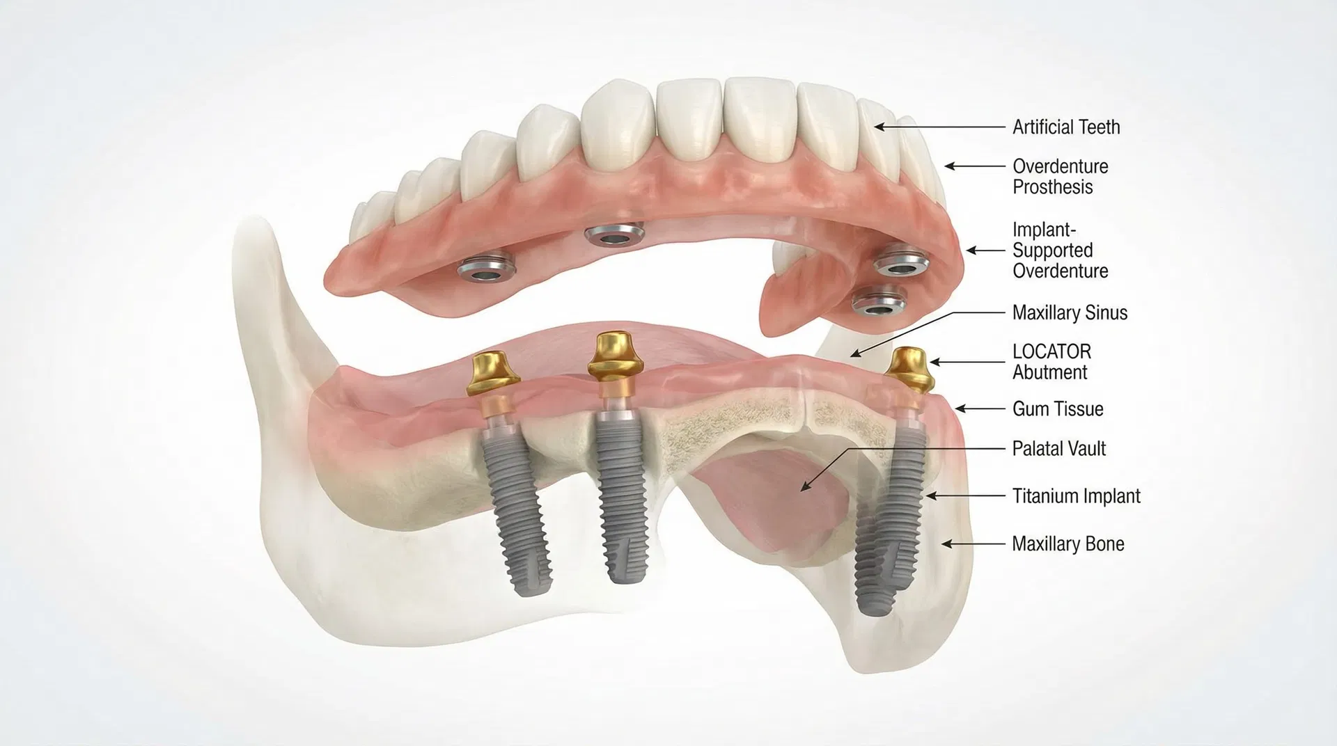 Maxillary 4-Implant Supported Overdenture with LOCATOR Attachments