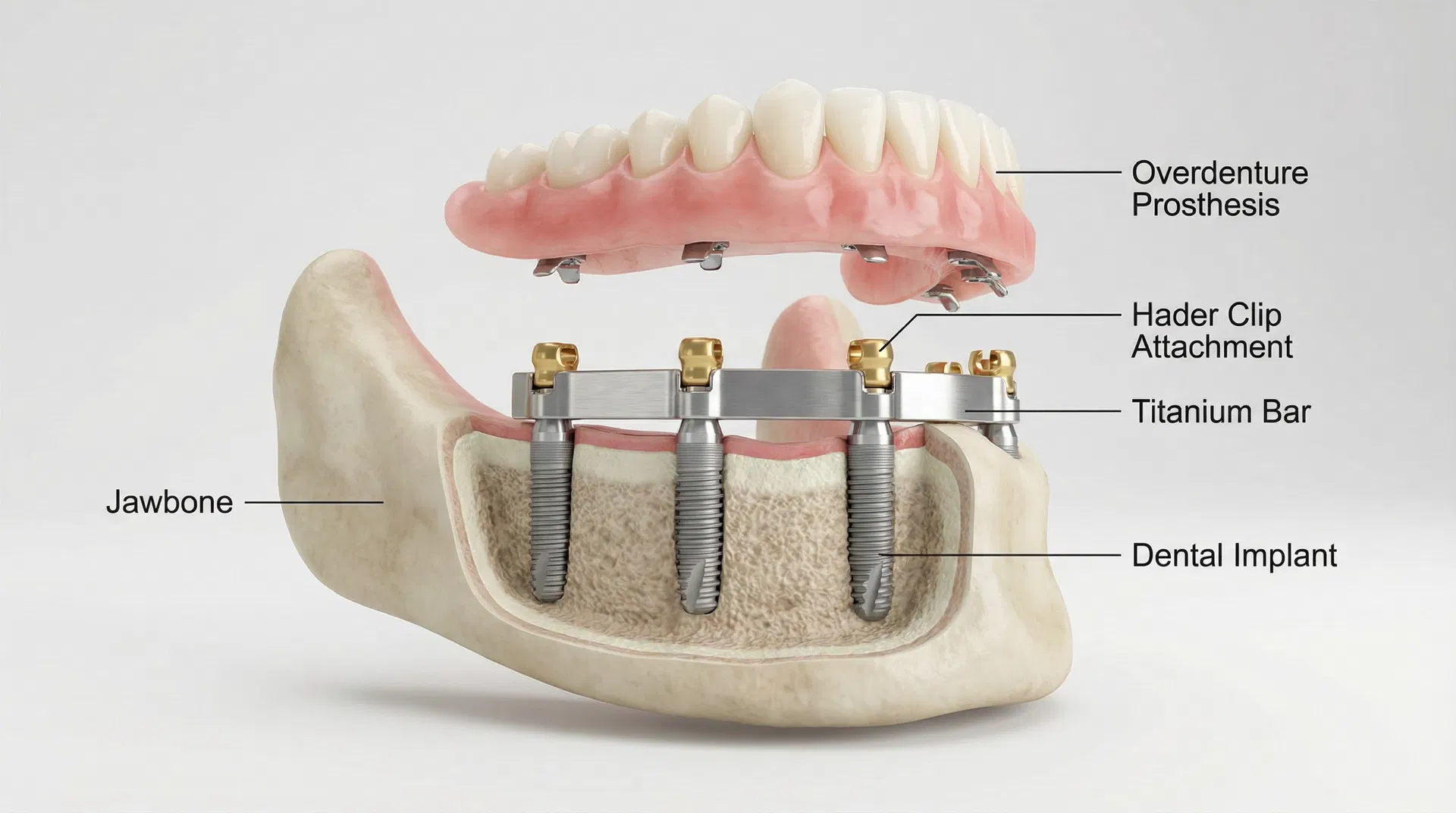 Bar-Retained Implant Overdenture — Hader Bar System