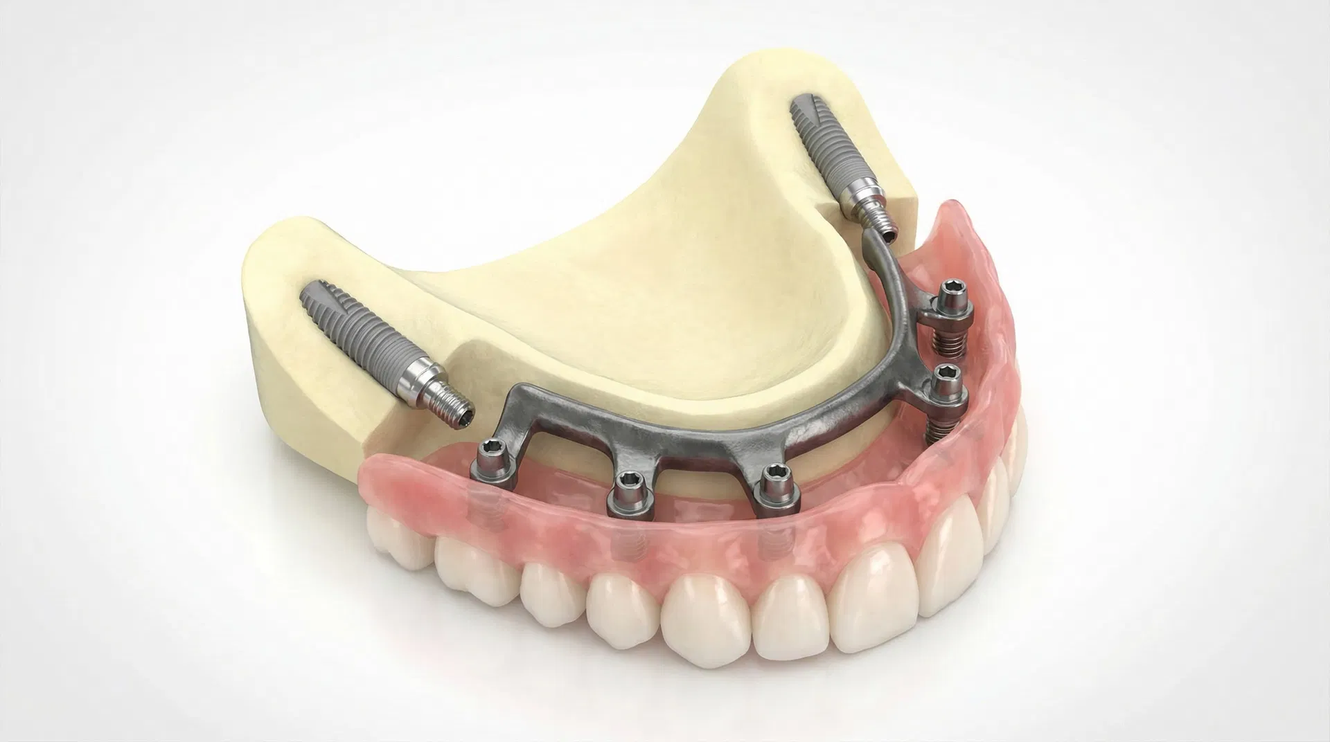 Maxillary Full-Arch Fixed LOCATOR F-Tx Prosthesis