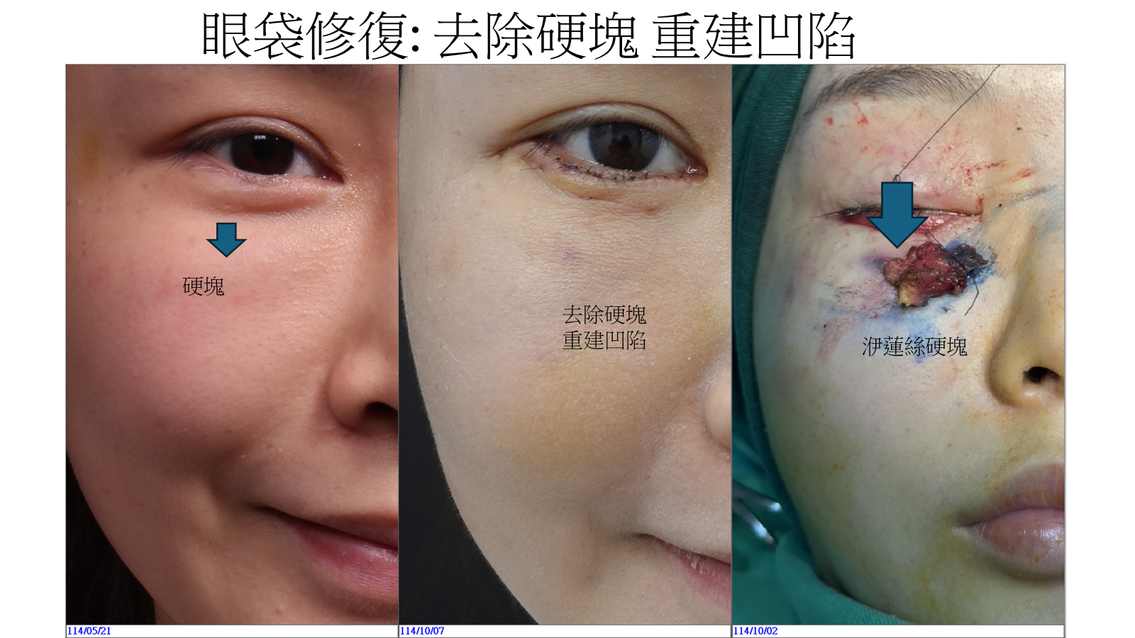 眼袋修復手術案例