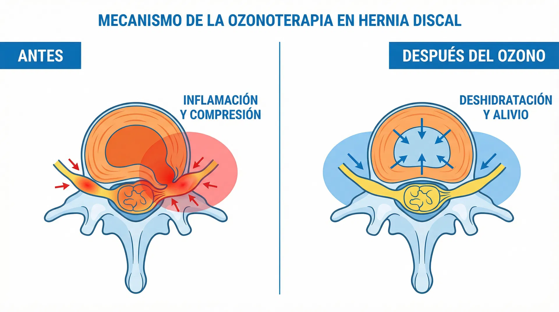 Mecanismo de acción del ozono en hernia discal