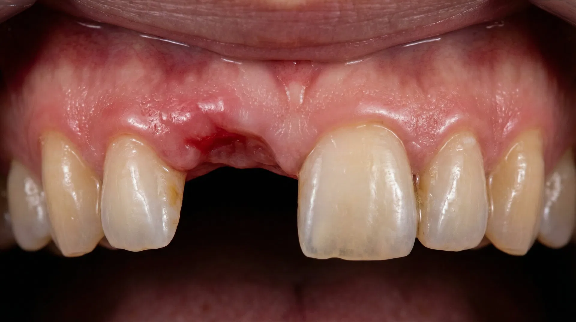 Before Single Tooth Implant treatment