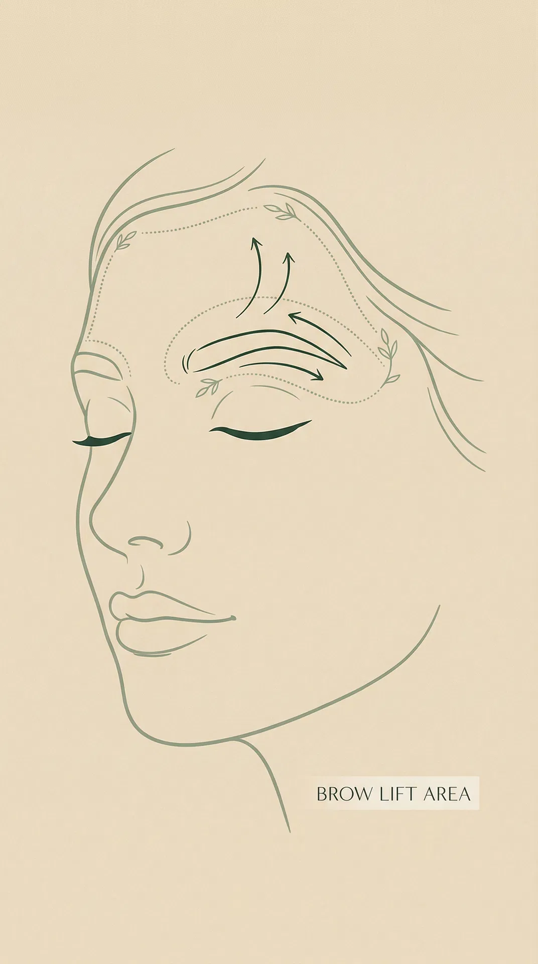 Brow Lift Procedure Illustration