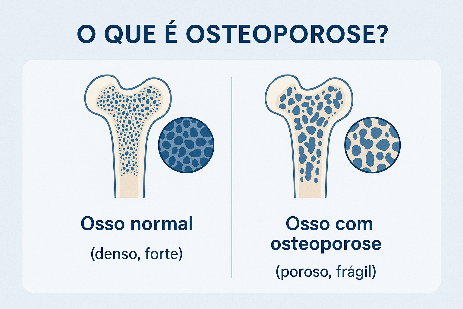 Osteoporose - Definição