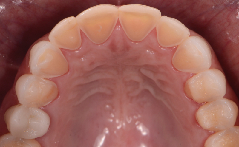 Exemplo de erosão ácida severa nos dentes