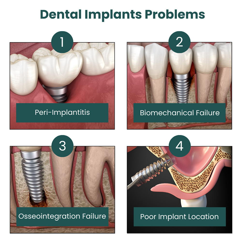 Problemas com implantes dentários