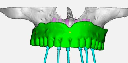 Planejamento digital de implantes