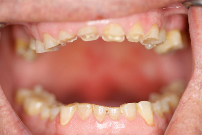 Dentes desgastados pelo bruxismo