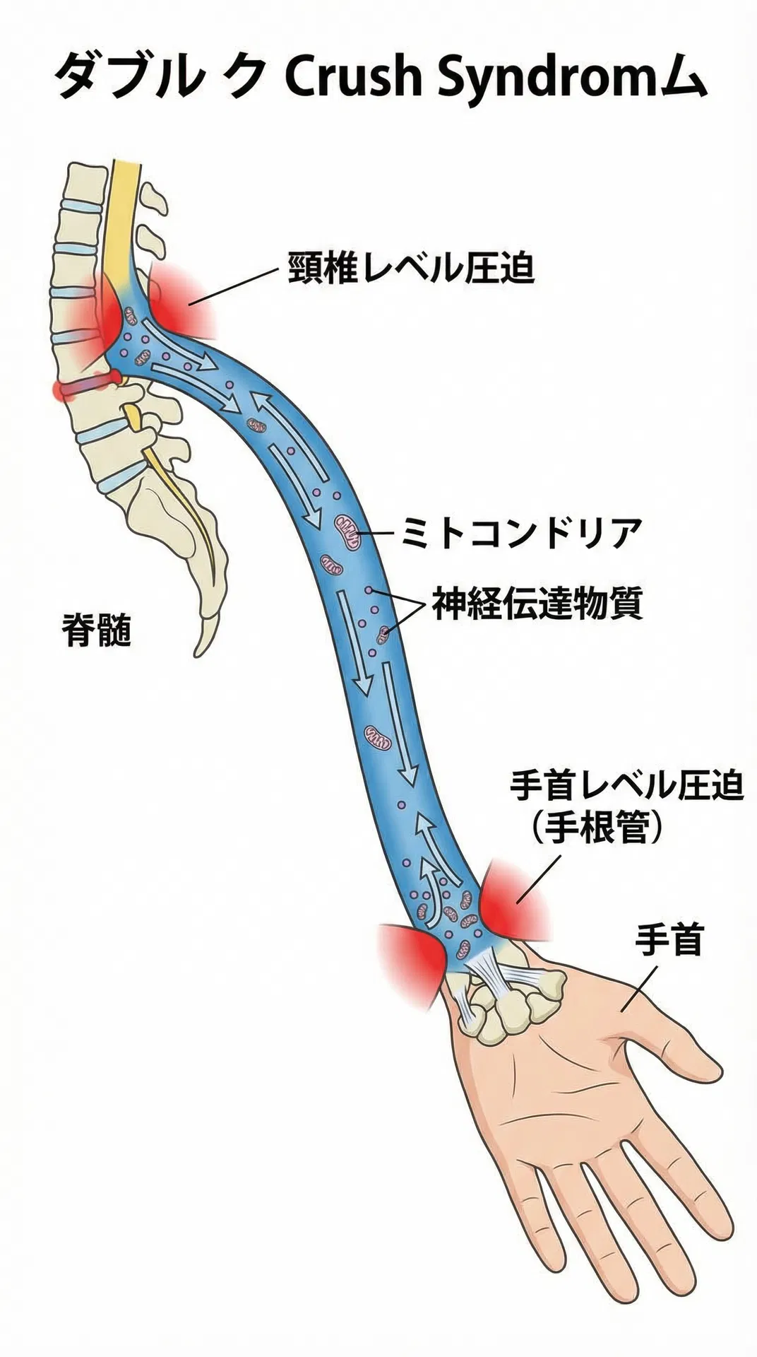 ダブルクラッシュシンドロームの軸索輸送障害