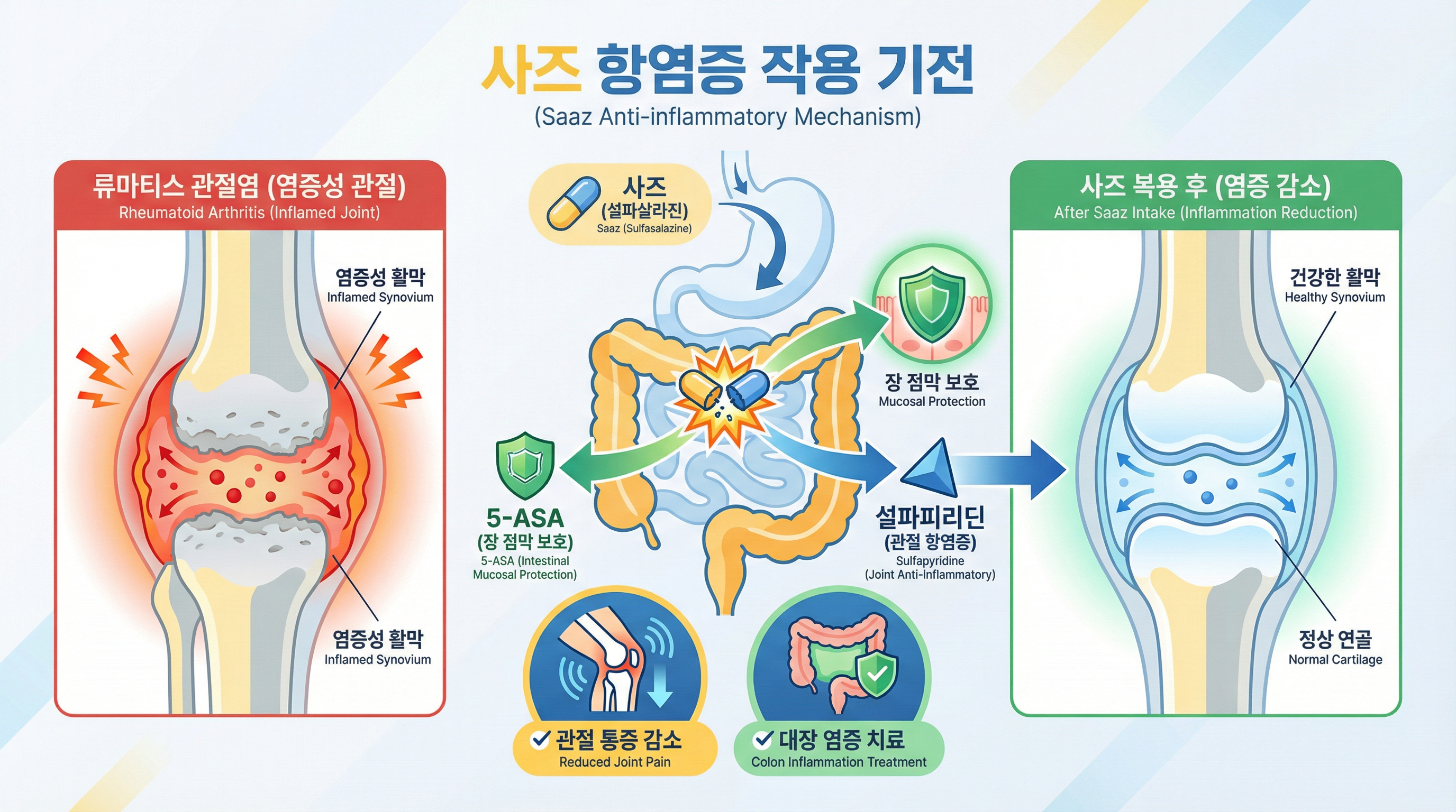설파살라진의 장내 분해 및 항염증 작용 메커니즘을 보여주는 인포그래픽
