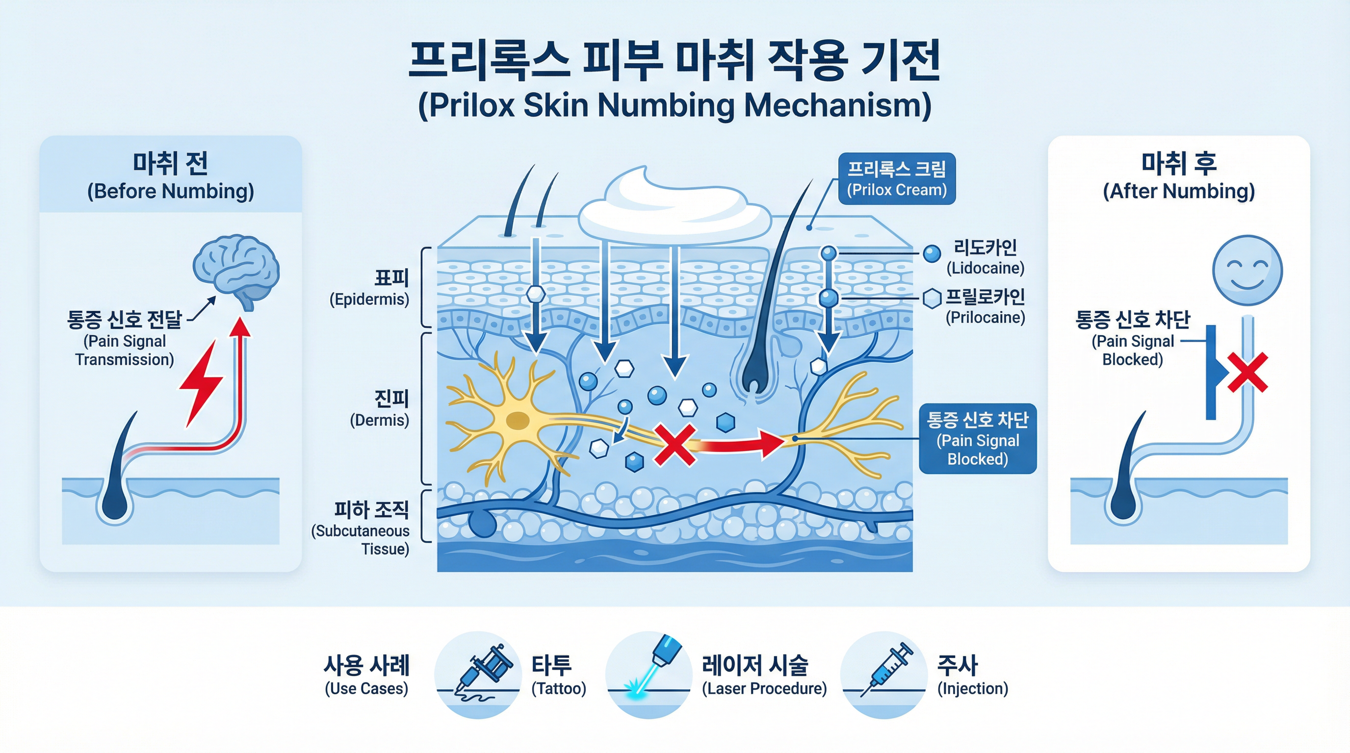 리도카인과 프릴로카인의 피부 신경 차단 메커니즘을 보여주는 인포그래픽