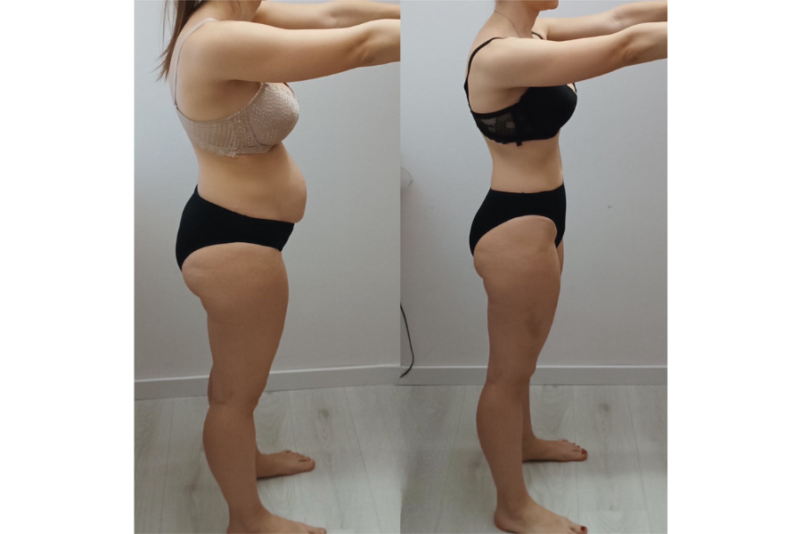 Andrea prije i poslije - prednji pogled