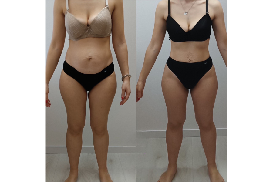 Andrea prije i poslije - bočni profil