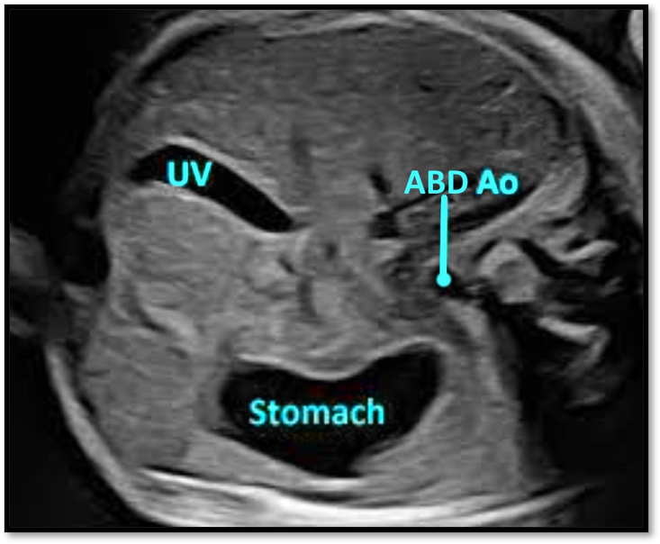 Abdominal Situs View echo