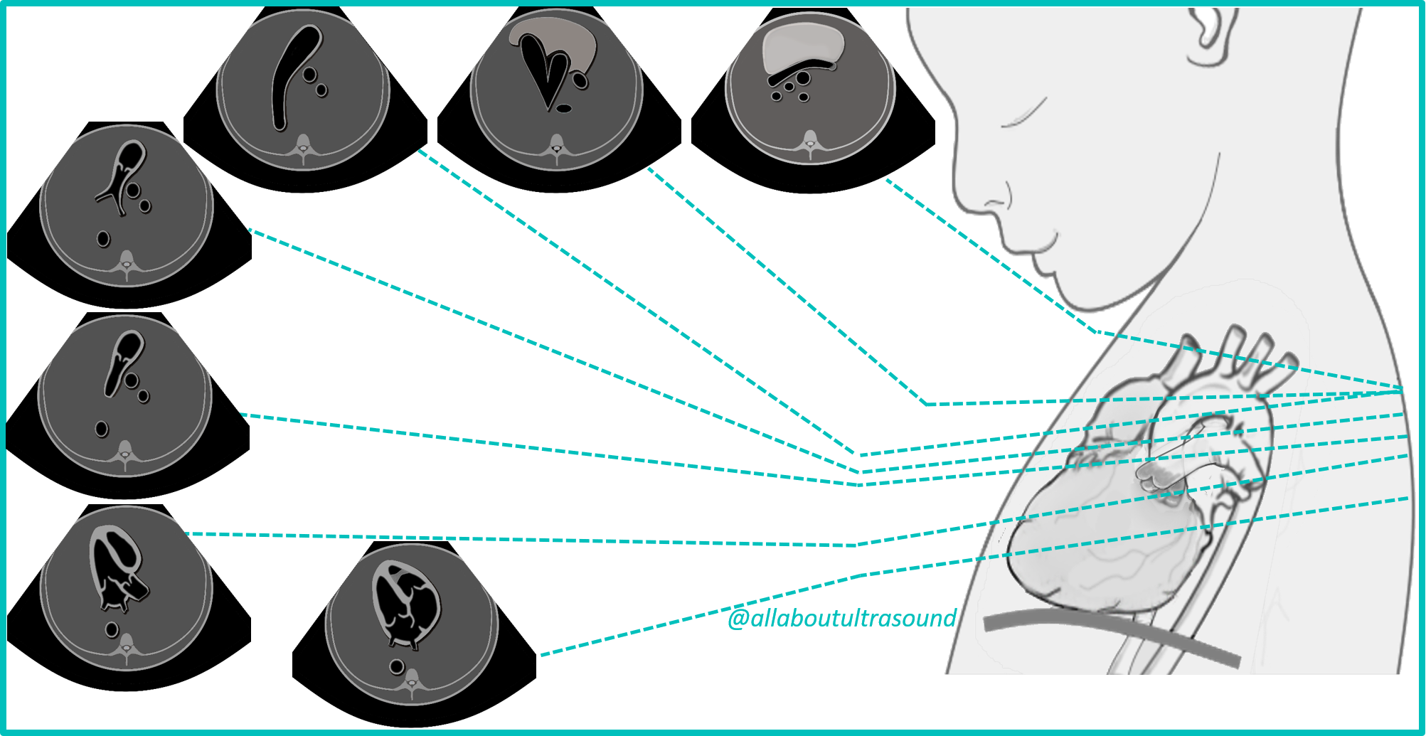 Fetal echo sweep overview